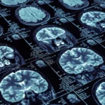 Avance en Alzheimer abre oportunidades en healthtech y sistemas ERP